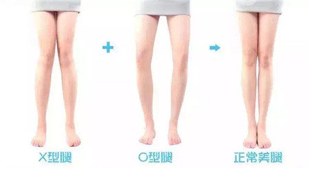 O型腿能矫正？O型腿矫正健美操，让你快速摆脱O型腿