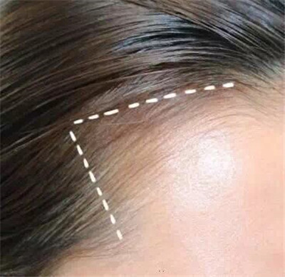 高圆圆美美的发际线遭遇危机？如何打造完美发际线