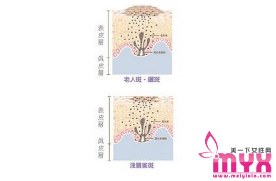 分辨你长的是什么斑的方法 分清类型才能对症下药