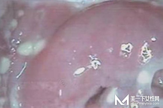 滴虫性阴炎严重吗 滴虫性阴炎早期症状白带图为你解秘