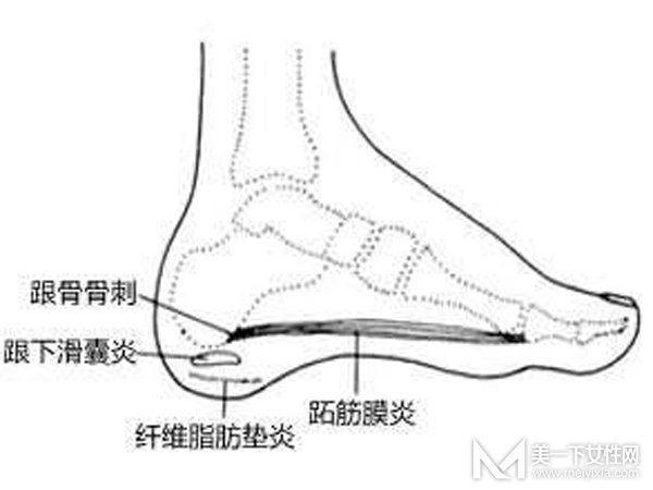 脚后跟疼是怎么回事 原因真相大揭秘