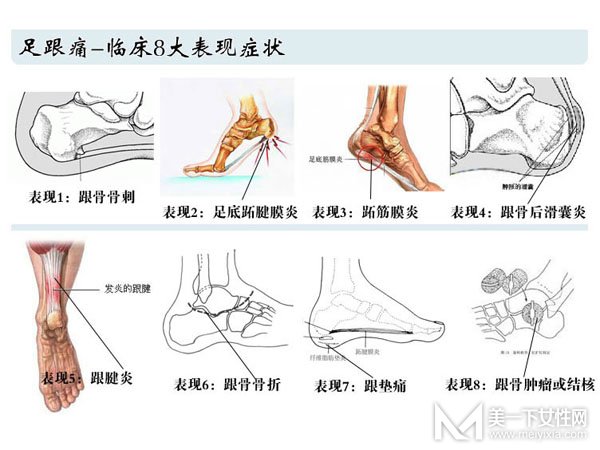 脚后跟疼是怎么回事 原因真相大揭秘