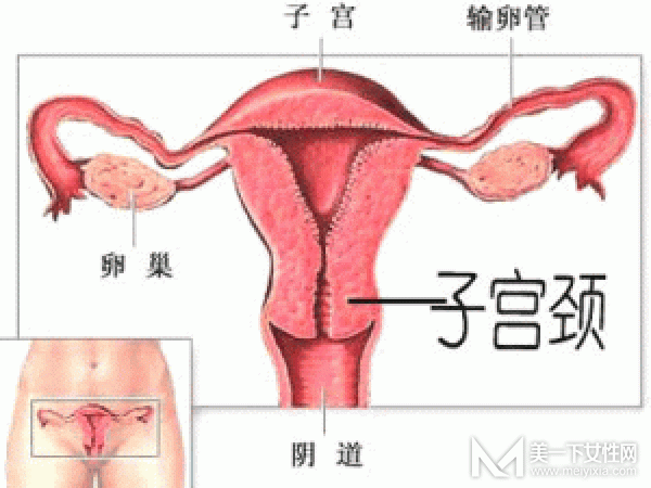 宫颈糜烂用什么药最好 怎样才能根治宫颈糜烂