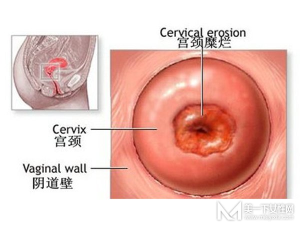 宫颈糜烂用什么药最好 怎样才能根治宫颈糜烂
