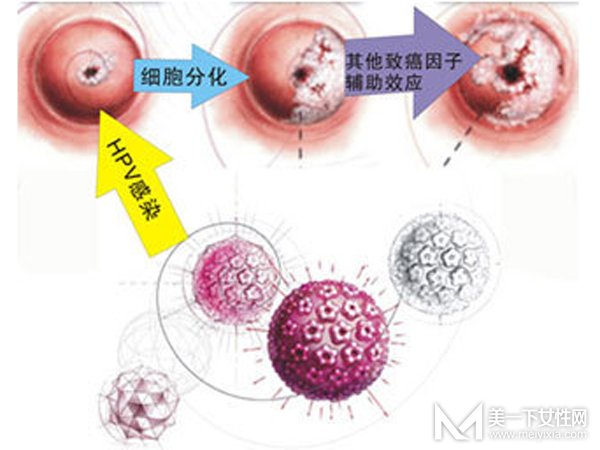 宫颈糜烂用什么药最好 怎样才能根治宫颈糜烂