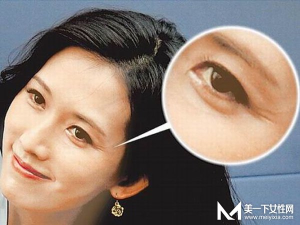 消除鱼尾纹的小窍门 和鱼尾纹说拜拜