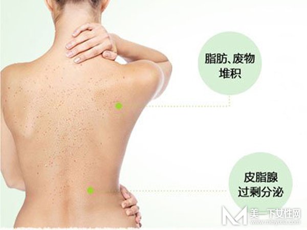 背后长痘痘是什么原因 背后长痘痘应该怎么办