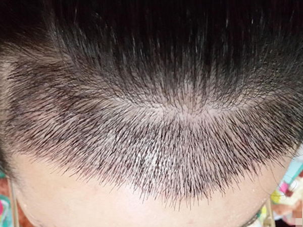头发种植多少钱 头发种植的手术过程是什么