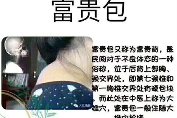 颈椎富贵包是怎么形成的 富贵包调整方法