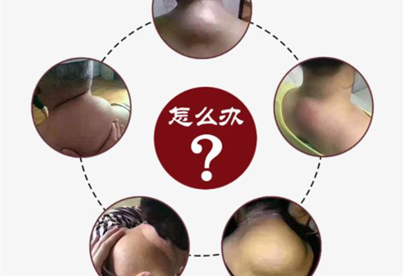 颈椎富贵包是怎么形成的 富贵包调整方法