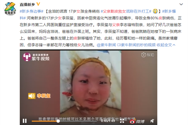 父亲割皮救女 父亲含泪的谎言伟大的父爱