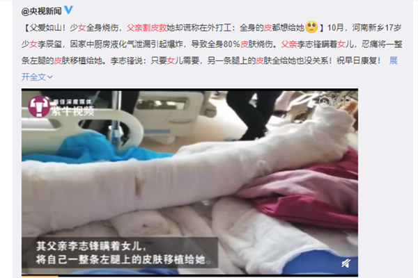 父亲割皮救女 父亲含泪的谎言伟大的父爱