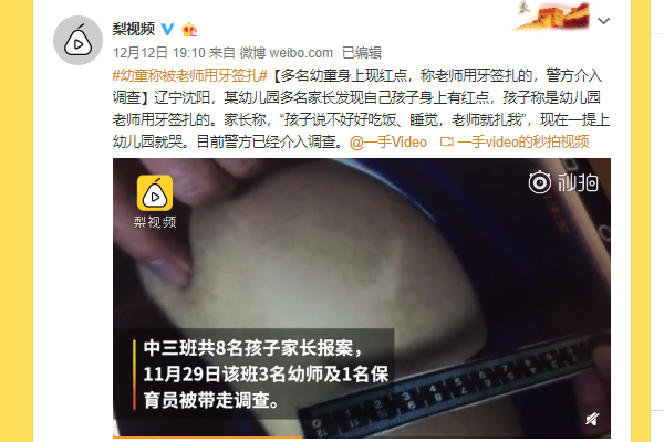 老师牙签扎幼童 孩子身上小红点触目惊心