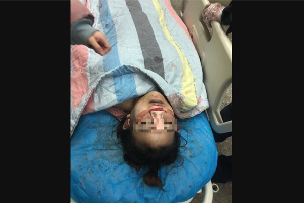 贵阳19岁女孩隆鼻死亡 死亡现场曝光医院竟销毁证据