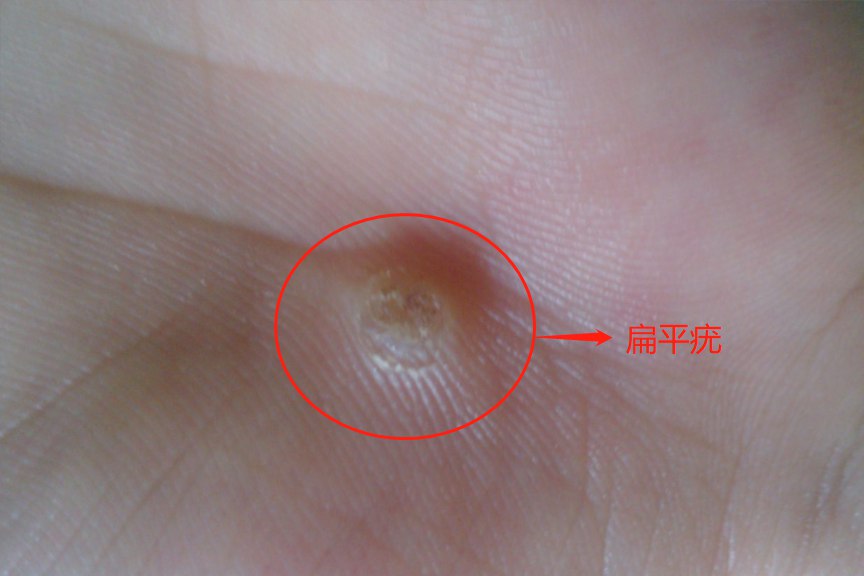 女性扁平疣