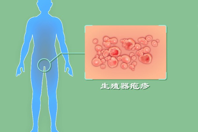 生殖器疱疹图片