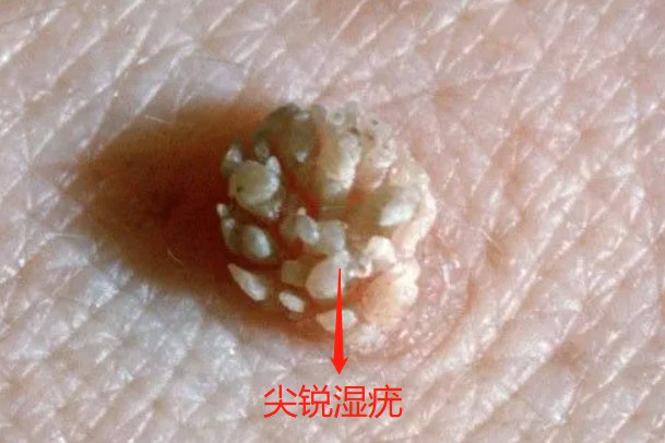 女性尖锐湿疣