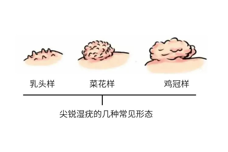 女性真疣