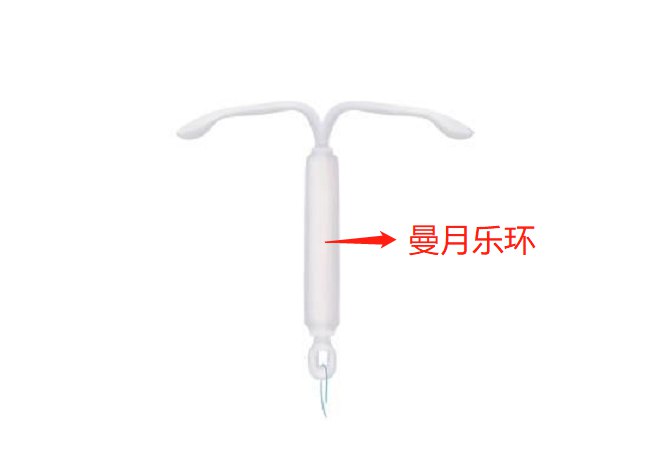 左炔诺孕酮宫内节育系统
